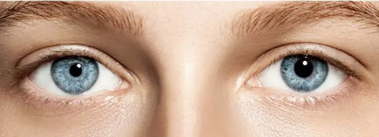 Uma pupila maior que a outra: entenda a anisocoria